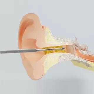 REUSEME Ohr Reinigungs Tool